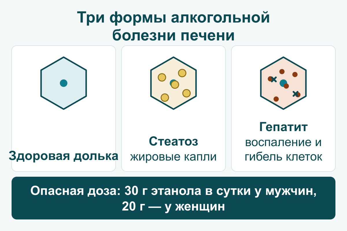 Схема: три формы алкогольной болезни печени на дольках — здоровая долька, стеатоз с жировыми каплями, гепатит с воспалением и гибелью клеток
